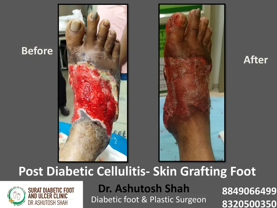 Diabetic Cellulitis and Coverage.pptx-13.webp